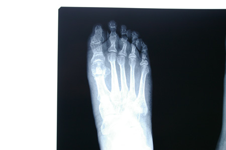 Radiografia post operat�ria